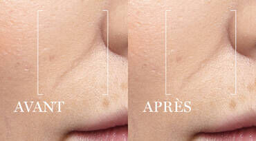 A side-by-side comparison of a person's cheek, labeled "AVANT" (before) on the left and "APRES" (after) on the right, showing noticeable improvements in skin texture and appearance.
