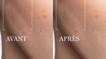 Before-and-after image showing skin with lighter spots. The left side labeled "AVANT" (before) displays darker spots, while the right side labeled "APRES" (after) shows a smoother complexion with reduced blemishes.