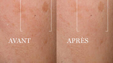 Before and after image of skin showing improvement; the left side is labeled "AVANT" (before) and the right side is labeled "APRES" (after).